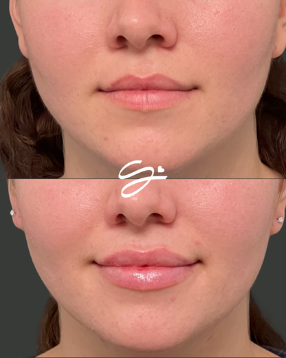 Lip Filler + Botox (20 FREE UNITS)