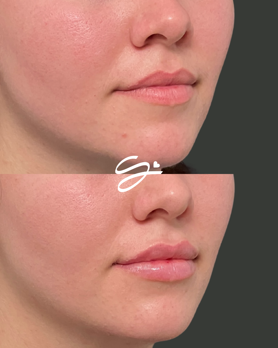 Lip Filler + Botox (20 FREE UNITS)