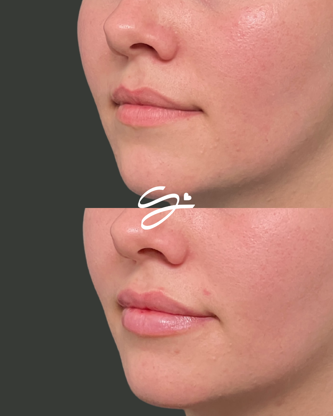 Lip Filler + Botox (20 FREE UNITS)