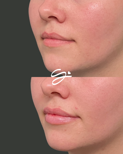 Lip Filler + Botox (20 FREE UNITS)