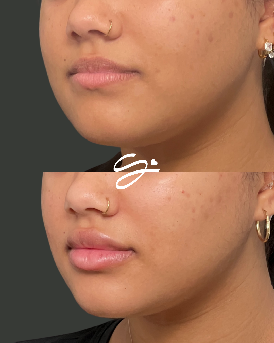 Lip Filler + Botox (20 FREE UNITS)