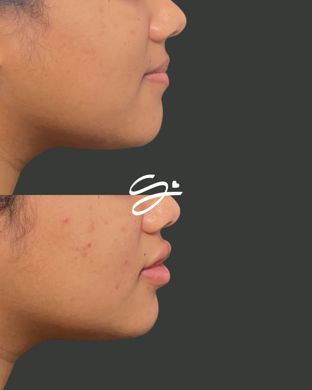 Lip Filler + Botox (20 FREE UNITS)